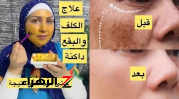 «دلعي جوزك يامدام»..كريم طبيعي هيقضي على الكلف والبقع الداكنة ويخلي وشك ينور زي البدر “شبابك راجع 10 سنين”!!!!