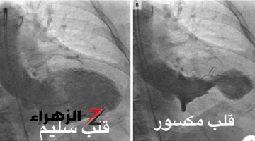 معلومات من ذهب…أفضل طرق الوقاية من القلب المكسور.. لو تعرضت للحزن والعصبية الشديدة!