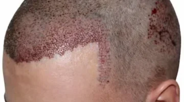 “قصة اغرب من الخيال”.. زراعة شعر تحول إلى كابوس اعتقال رجل على متن طائرة بسبب نزيف في الرأس