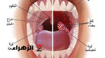 طرق مذهلة لعلاج ألم والتهاب الحلق واللوزتين للأبد في 5 دقائق فقط