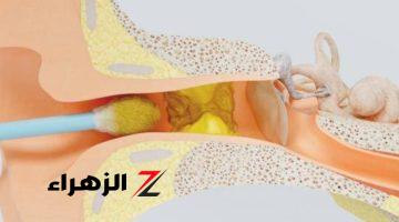 «ضيعت عمرك بتنظفها غلط»…  3 وسائل آمنة لتنظيف وازاله شمع الاذن بدون تعرضها للضرر او الالتهاب… نصيحة من الدكتور!!