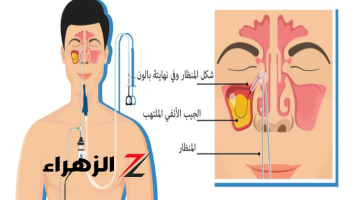 أسباب إلتهاب الجيوب الأنفية في الصيف ووصفة سحرية لعلاج الجيوب الأنفية