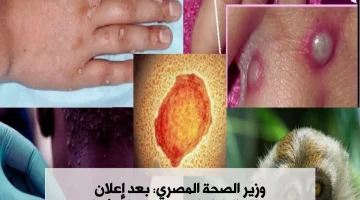 «مصر تعلن الحرب الطبي»…. إجراءات مشددة في مصر لمكافحة جدري القردة