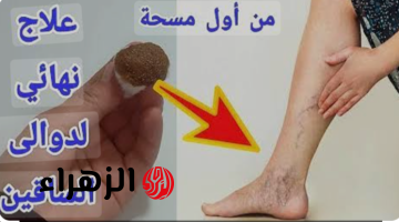 «العشبة المعجزة».. أسهل طريقة لعلاج دوالى الساقين..  لن تصدقى هذه معجزة!!