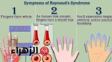 اختبار مدته دقيقة يكشف إذا كنت تعاني من مرض برودة الأطراف “رينود”