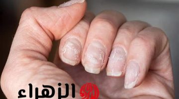 لا تتجاهلها أبدًا.. علامة على الأظافر تنذرك بارتفاع الكوليسترول في الدم