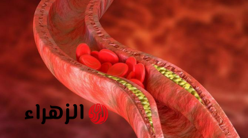 هتندم ندم عمرك لو معرفتش..علامات تدل على ارتفاع نسبة الكولسترول في الدم..تعرف عليها واذهب للطبيب