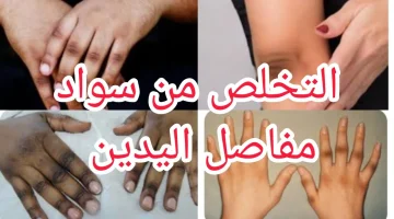 وصفات طبيعية للتخلص من إسمرار مفاصل الأصابع والحصول على التفتيح المطلوب !!