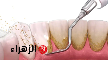 “أبرزها استخدام قشر البرتقال” 7 طرق طبيعية وفعّالة لإزالة الجير من الأسنان: اكتشف أفضل الحيل المنزلية!