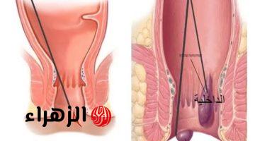 “انسى طريق الدكاترة بعد النهاردة”.. عشبة سحرية تعالج البواسير نهائيا في المنزل وبدون عمليات جراحية.. ضاع عمرنا واحنا منعرفهاش!!