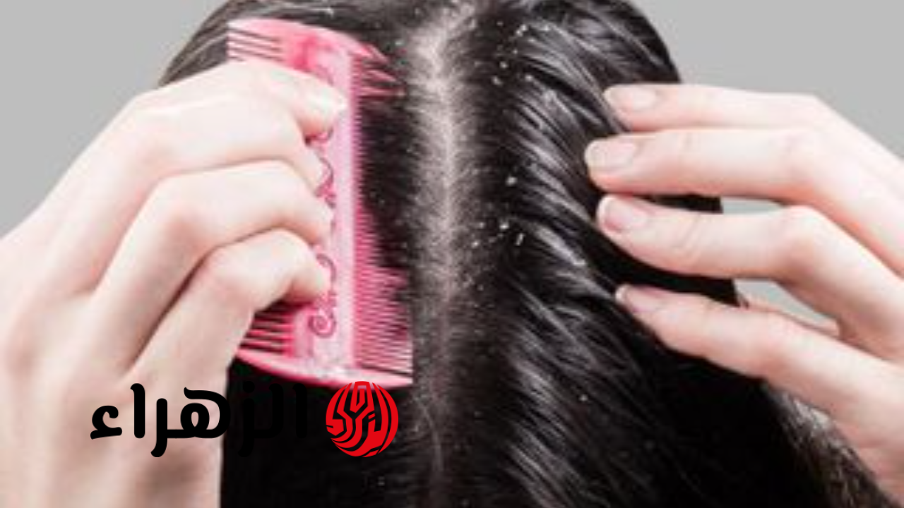 47 190215 tips get rid dandruff 700x400 1280x720 1