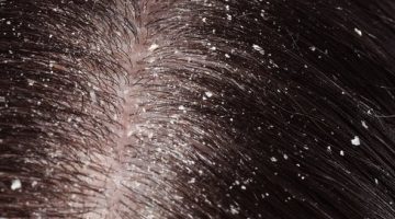 يطرد القمل ويعالج فطريات الأظافر.. زيت خارق لمشاكل الجلد والشعر