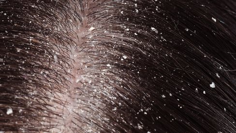 يطرد القمل ويعالج فطريات الأظافر.. زيت خارق لمشاكل الجلد والشعر