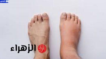 كيفية التخلص من الماء الزائد في الجسم وما هي اسباب احتباس الماء واضراره