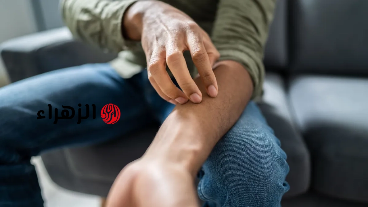 الحزاز العقدي – هل يمكن أن تساعد العلاجات المنزلية؟