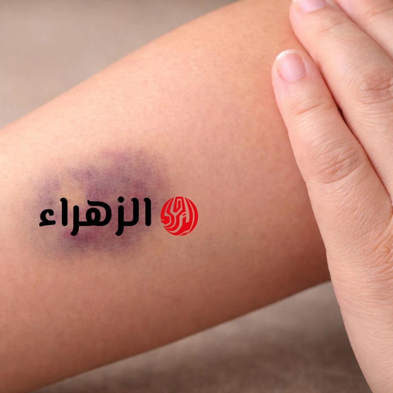 لماذا تظهر الكدمات الزرقاء دون إصابة إليك الأسباب ومتى تقلق